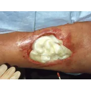TEGADERM™ ALGINATE – Pansament avansat pentru răni cu exsudat