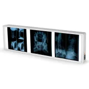 Negastoscop medical cu 3 panouri 38 × 122 cm (1 buc)