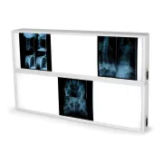 Negastoscop medical cu 2×3 panouri 76 × 122 cm (1 buc)