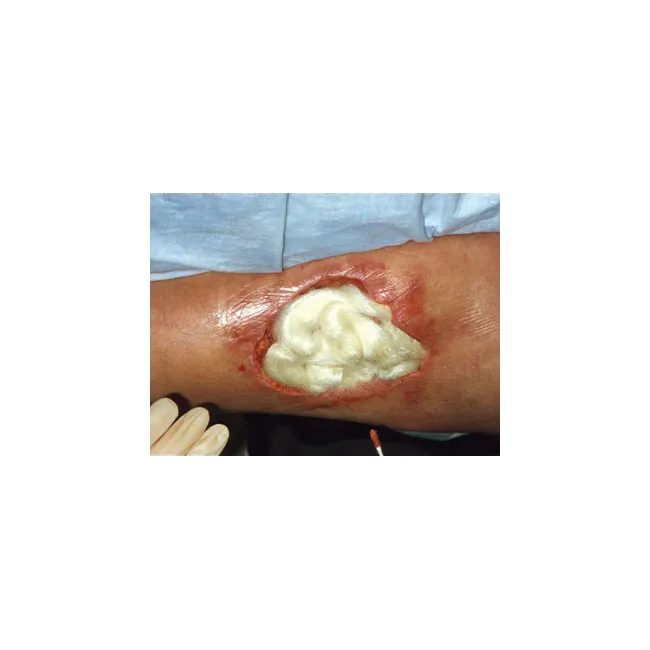 TEGADERM™ ALGINATE – Pansament avansat pentru răni cu exsudat